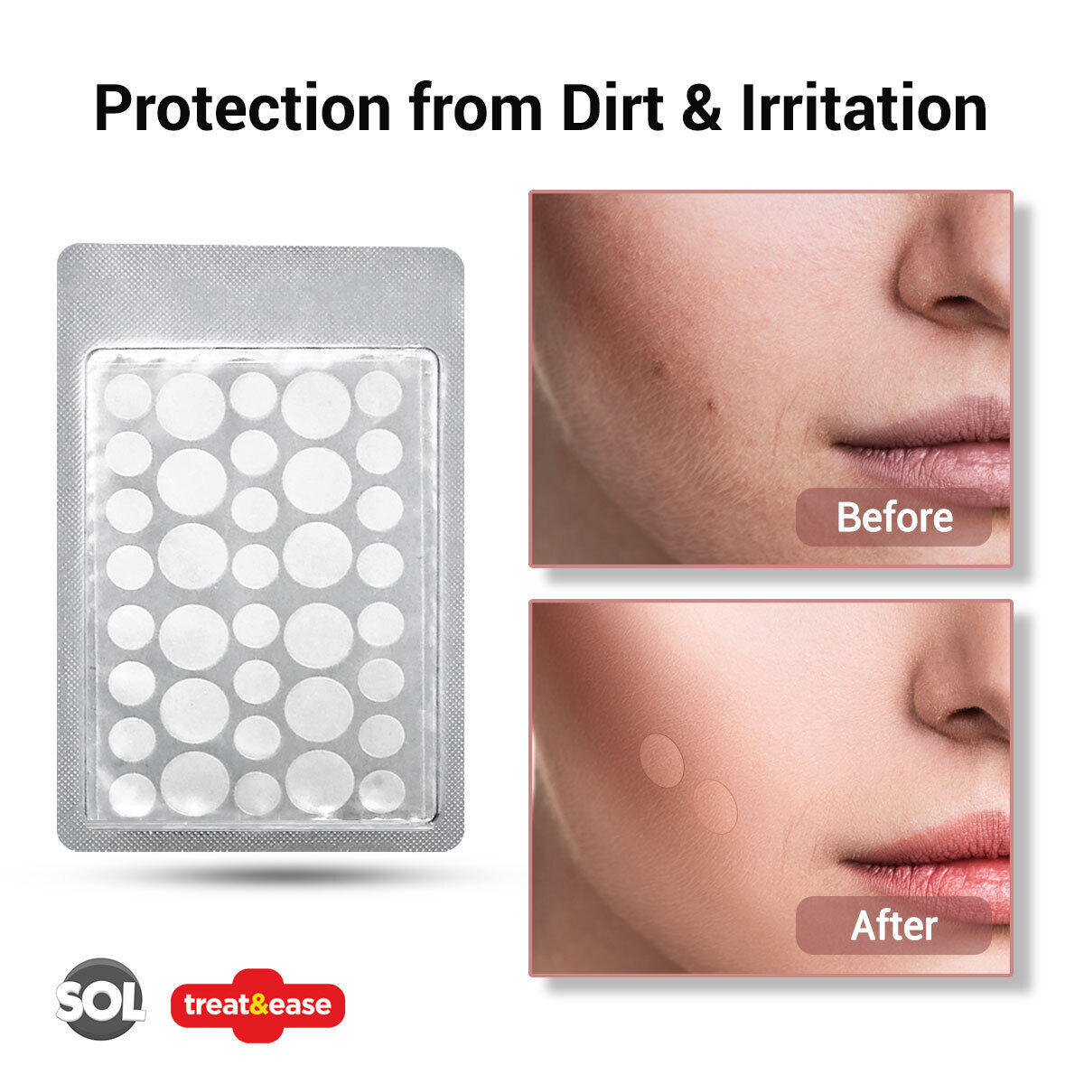 Cold Sore Patches Acne Blemish Hydrocolloid Patch | 36 Pack