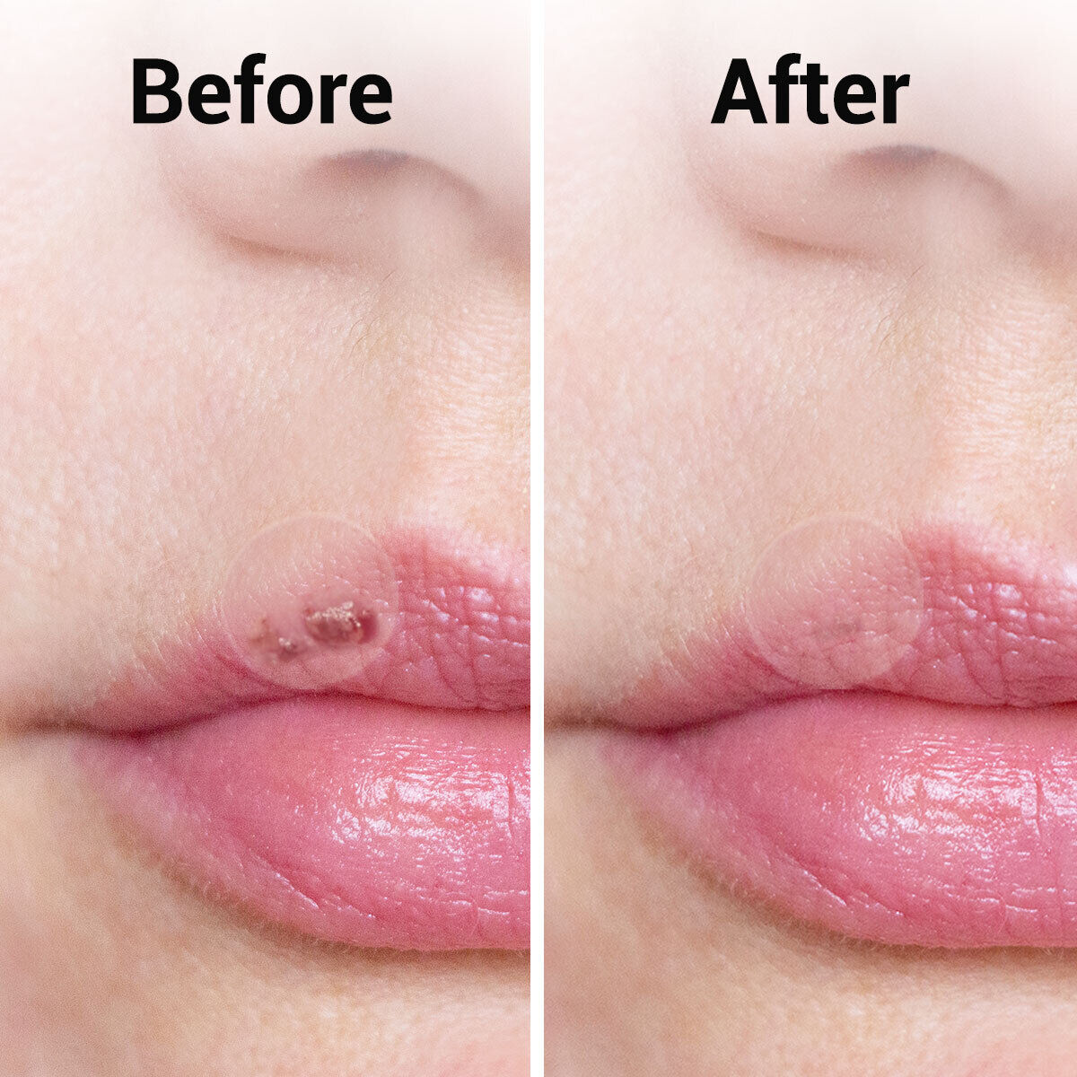 Cold Sore Patches Acne Blemish Hydrocolloid Patch | 36 Pack