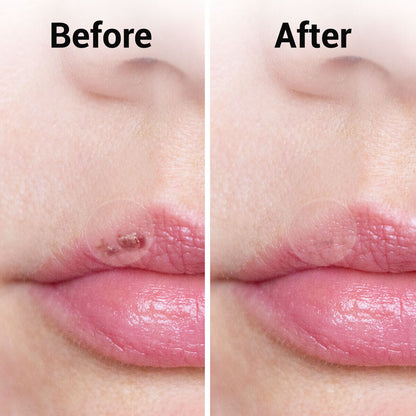 36 Cold Sore Patches Acne Spot Pimple Skin Breathable Blemish Hydrocolloid Patch